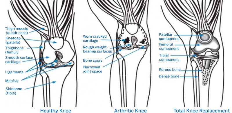 Graphic showing elements of the healthy knee, arthritic knee, and total knee replacement.