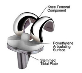 An image of a knee replacement implant from an article about Arthritis of the Knee from Hospital for Special Surgery