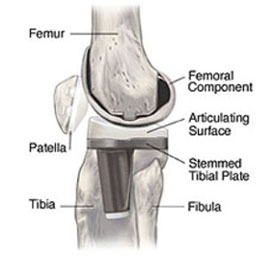 knee joint replacement devices