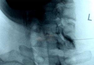 Fluoroscopic image of Left C6/7 transforaminal epidural injection from an article on Cervical Radiculopathy from Hospital for Special Surgery