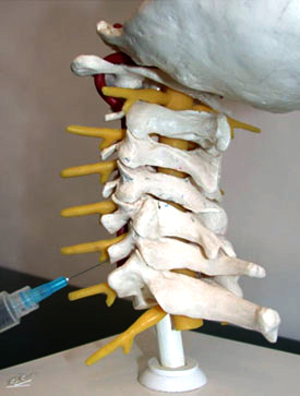 Image of a model for transforaminal epidural steroid injection from an article on Cervical Radiculopathy for Hospital for Special Surgery