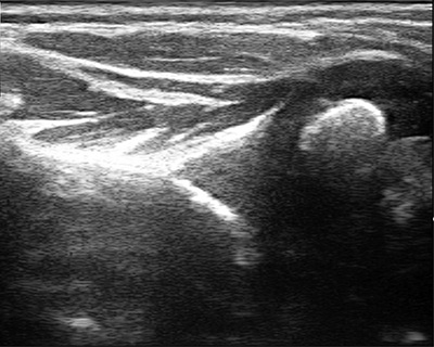 Ultrasound image of shoulder with severe glenohumeral dysplasia.