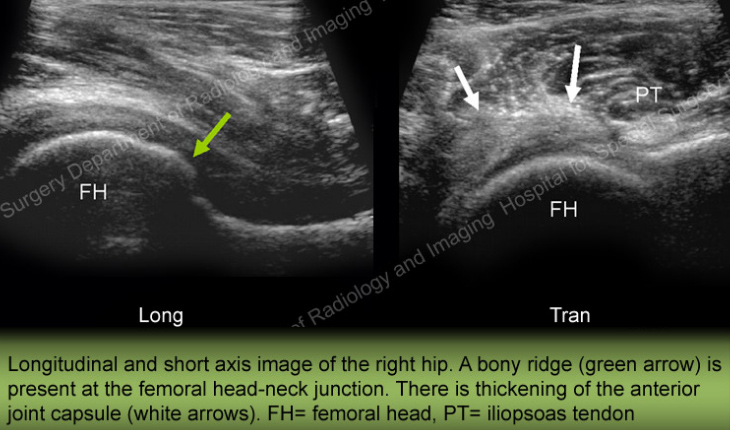 Image: Ultrasound of a right hip with osteoarthritis showing bony ridge and thickened joint capsule.