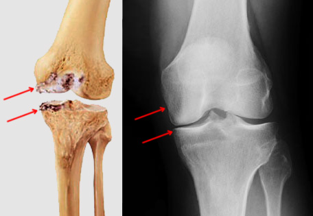 Illustration and X-ray showing location of osteoarthritis in the medial (inner) compartment of the knee.
