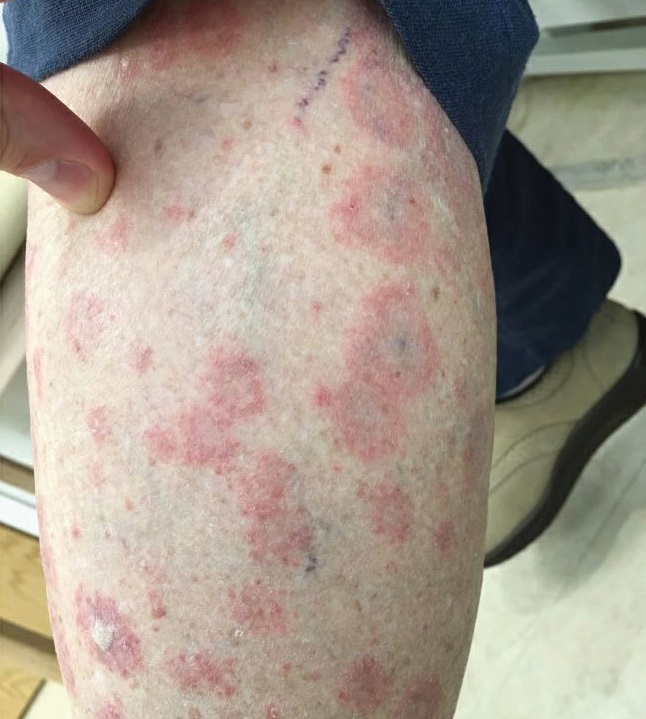 diffuse erythematous rash