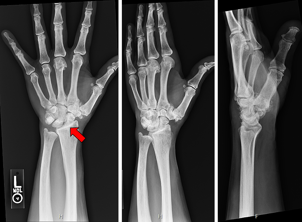 X-rays of a patient with osteoarthritis at the radiocarpal joint resulting in painful bone-on-bone contact. The surgeon would like to perform a total wrist arthroplasty (TWA).