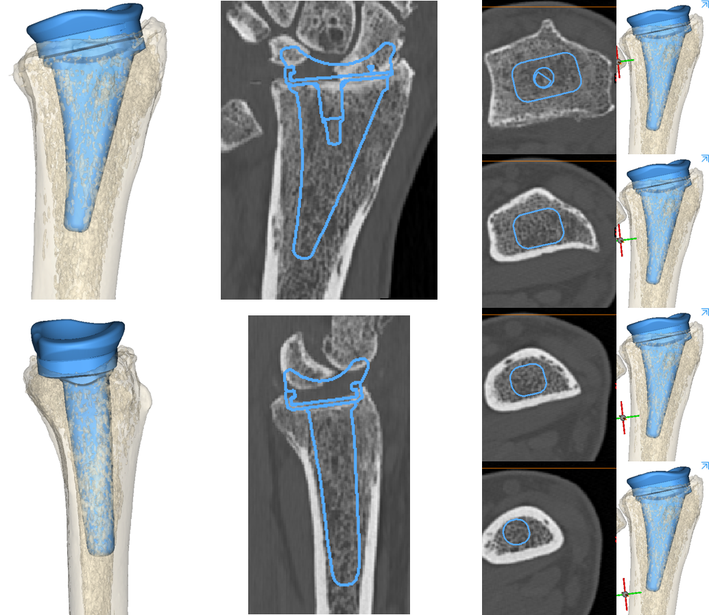 The Device Development team creates 3D reconstructions of the bone to template the size and position of the radial component of the TWA (blue).