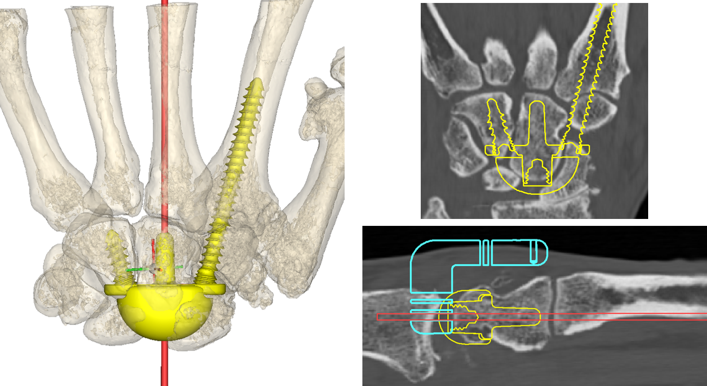 The carpal component of the TWA (yellow) is also templated for size and position.