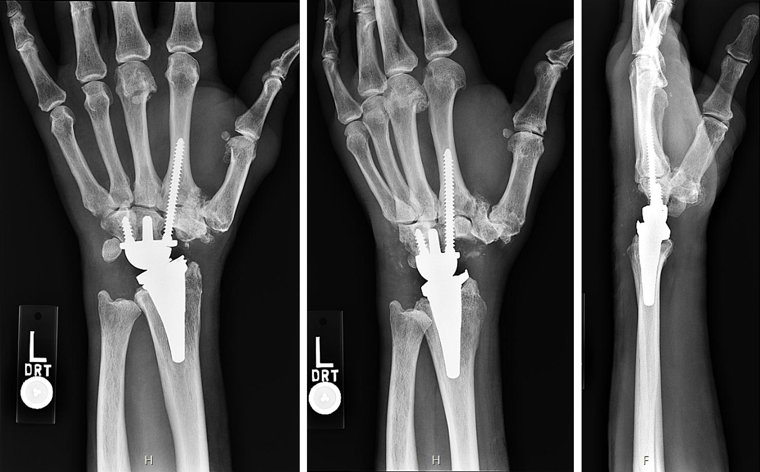 Postoperative X-rays showing the implanted total wrist replacement. Both components match the plan well and appear sized and positioned appropriately.
