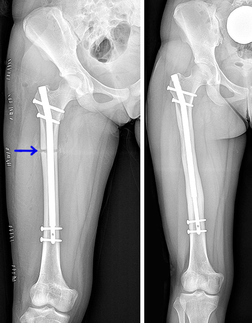 X-rays showing an implanted intramedullary rod for limb lengthening.