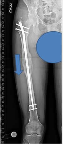 X-ray of a  femur and limb lengthening showing internal lengthening nail.