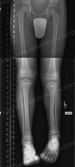 Limb Length Discrepancies in the Pediatric Patient - HSS.edu