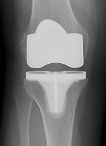 X-ray of a total knee arthroplasty from an article about Arthritis of the Knee from Hospital for Special Surgery