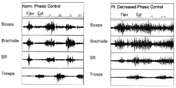 Electromyography (EMG) comparison image