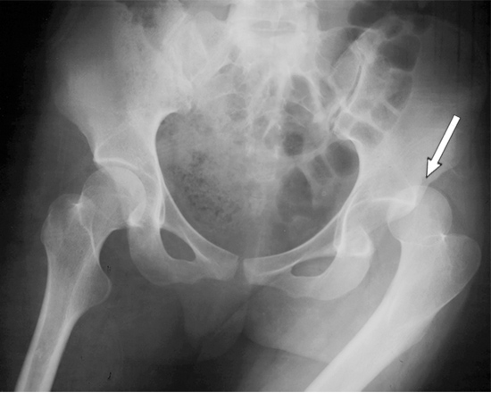 Anteroposterior (front to back) X-ray view of the pelvis with a posterior dislocation of the left hip