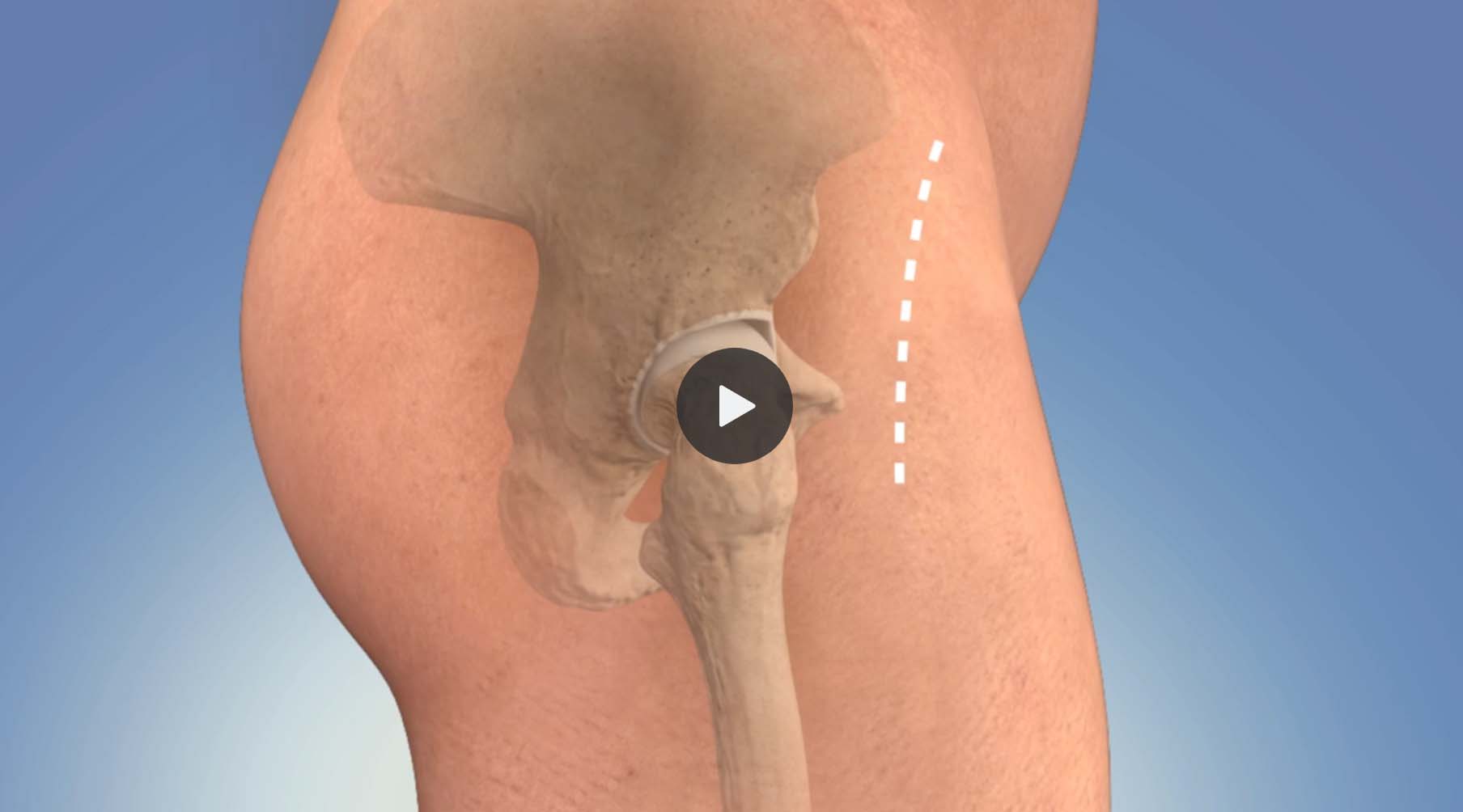 Animation: Hip Replacement - Anterior Approach