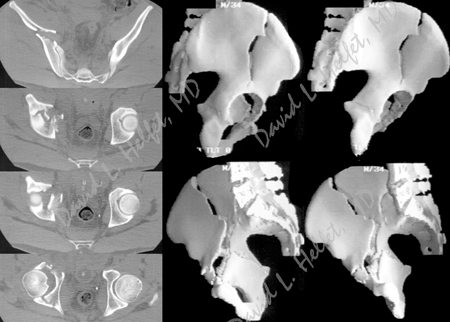 CT and 3D reconstruction images of acetabulum from a case example presented by the orthopedic trauma service at hospital for special surgery.