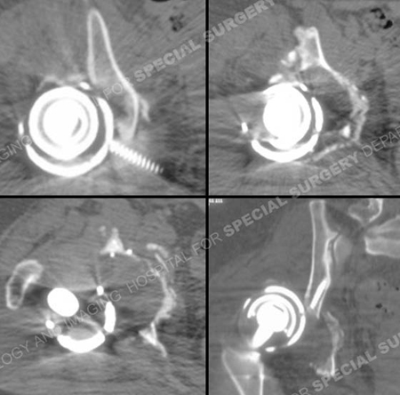 CT scan showing periprosthetic acetabular fracture from a case example presented by the orthopedic trauma service at Hospital for Special Surgery.