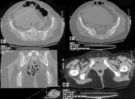 CT Scans of pelvis from Case Example presented by the Orthopedic Trauma Service at Hospital for Special Surgery.