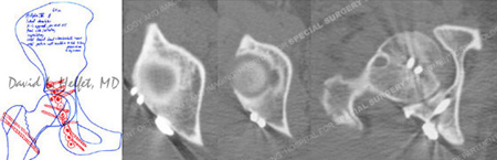 Pre-operative plan and post-operative CT-Scan of femoral head from a case example presented by the orthopedic trauma service at Hospital for Special Surgery.
