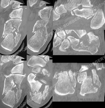 calcaneus fracture orthobullets