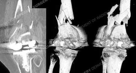 CT scan and 3D CT image revealing periprosthetic femur fracture from a case example presented by the orthopedic trauma service at Hospital for Special Surgery.