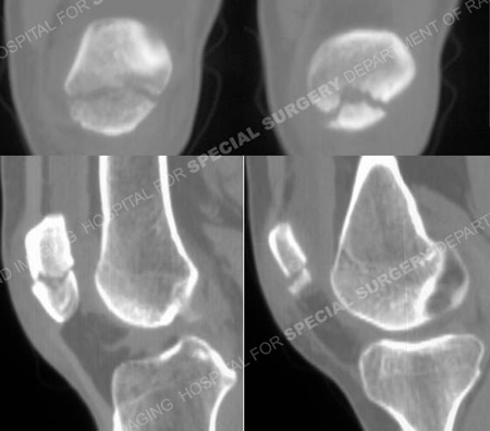 CT scan images of transverse patella fracture from a case example presented by the orthopedic trauma service at Hospital for Special Surgery.