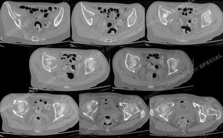 CT scans delineating acetabular fracture pattern from a case example presented by the orthopedic trauma service at Hospital for Special Surgery.