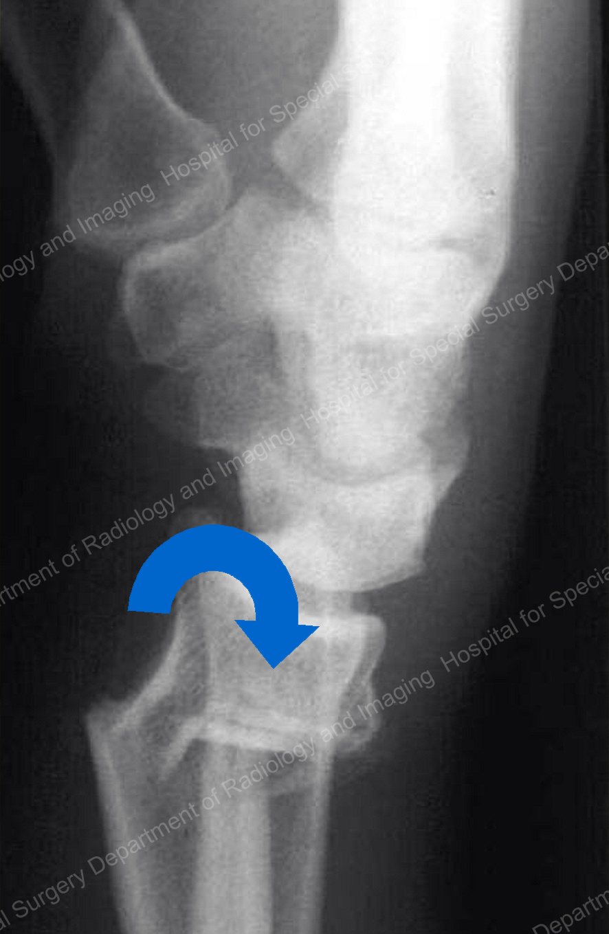 X-ray image of a Colles (dorsal) fracture