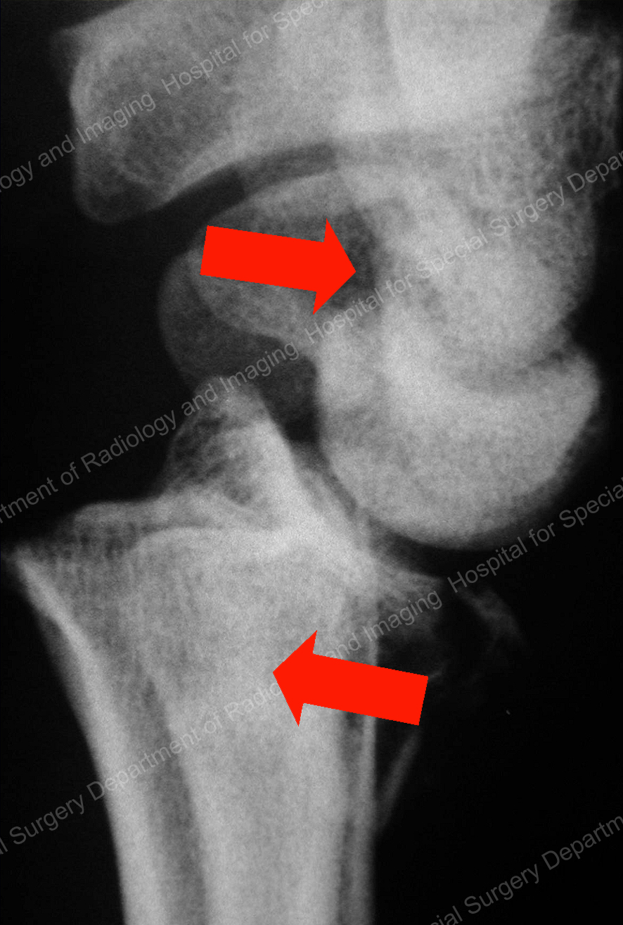 X-ray image of the shearing of a distal radius fracture of the wrist