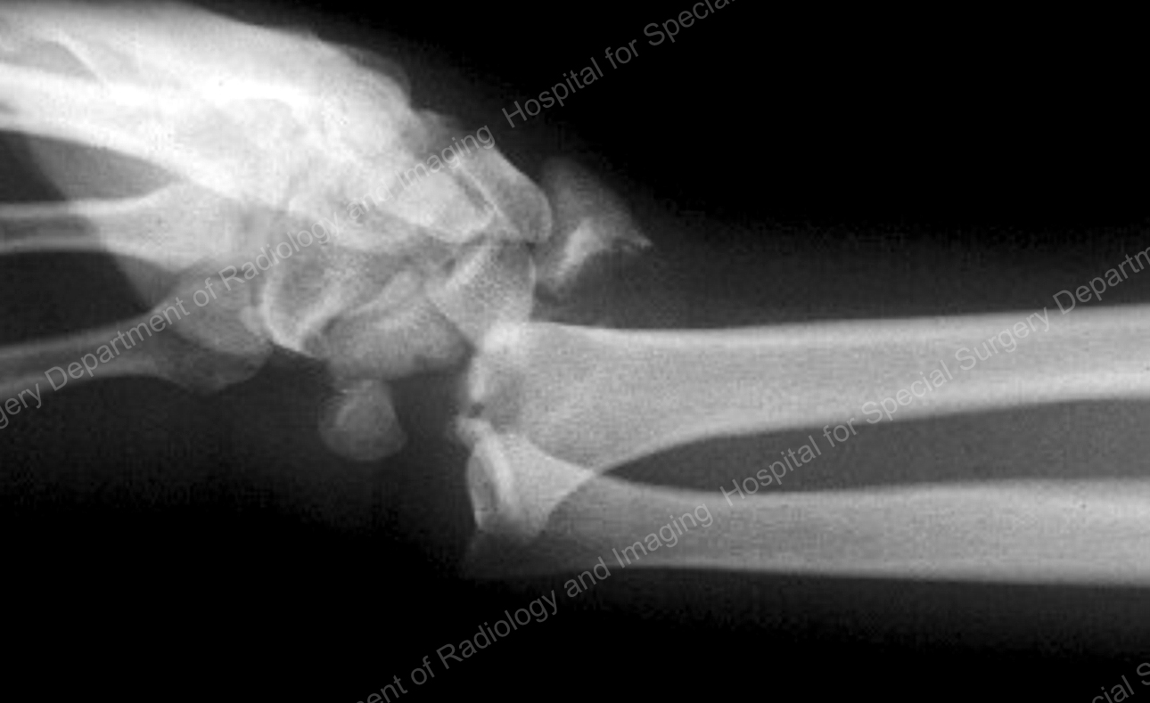 X-ray image showing a fracture-dislocation of the distal radius