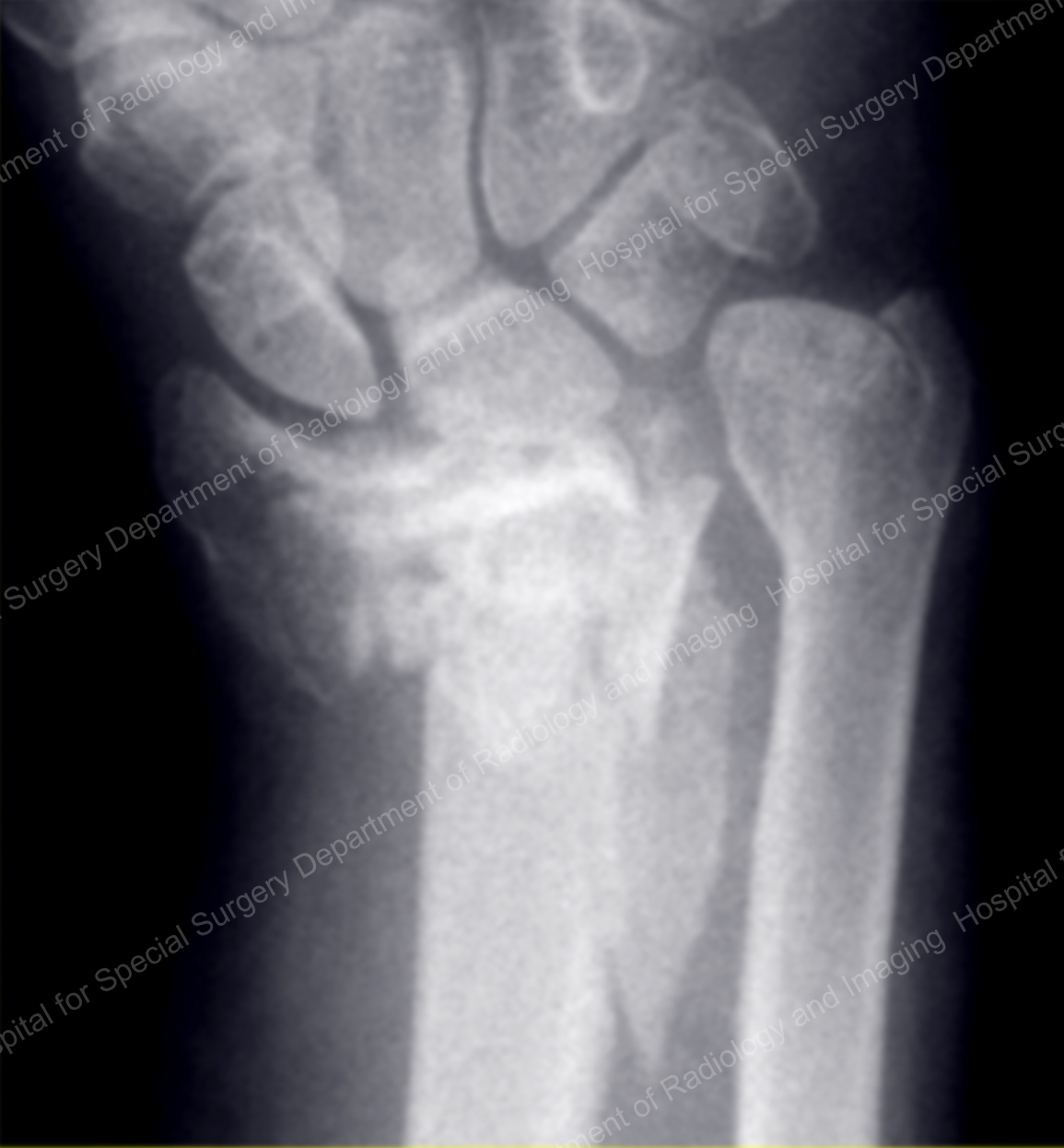 X-ray image showing a complex fracture of the distal radius