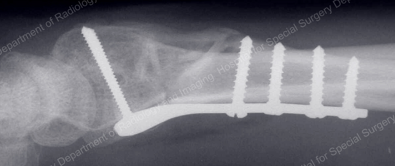 X-ray image showing the internal fixation of a distal radius fracture