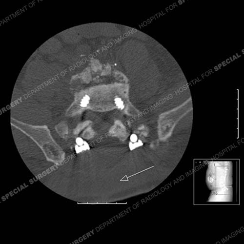 CT Scan of a bursa from instrumentation