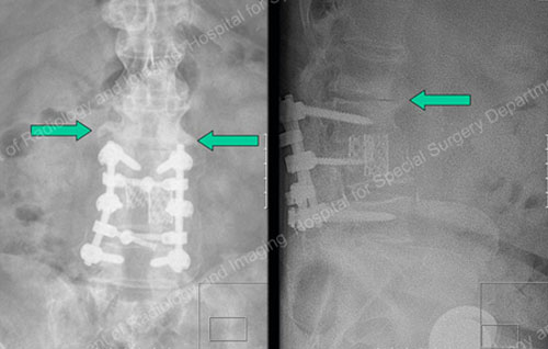 X-rays showing bone spurs adjacent to prior fusion.