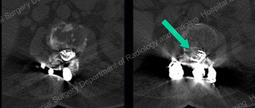 CT myelograms showing normal and pinched nerves