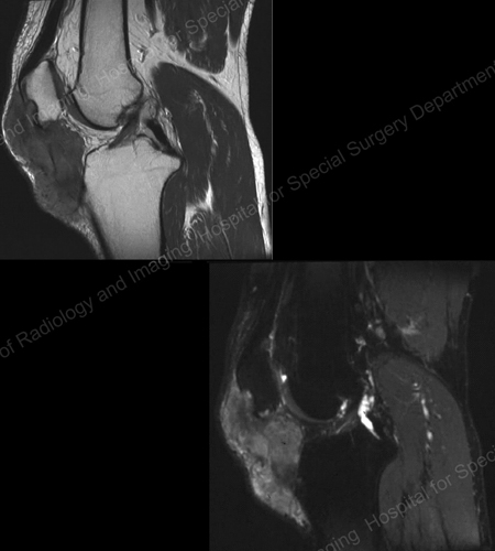 MRI of the knee showing gouty soft tissue mass and erosion of the kneecap