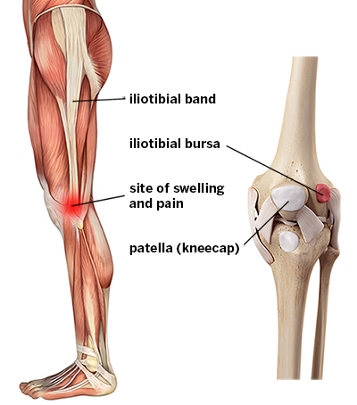 Illustration der Knochen und der Muskulatur des Kniegelenks mit Beschriftung des Iliotibialbandes, des iliotibialen Schleimbeutels, der Patella (Kniescheibe) und der Stelle, an der Schmerzen und Schwellungen beim IT-Band-Syndrom auftreten