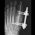 Salvage of Metatarsal Lengthening Nonunion with Structural Iliac Crest Autograft