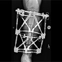 Proximal Tibial Bone Defect Treated with Intentional Deformity and Bone Transport