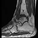 Ankle distraction arthroplasty and supramalleolar osteotomy