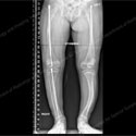 X-ray of limb length discrepancy