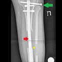 X-ray image of tibia