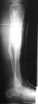 James, Follow-up Image, Distraction of a tibial non-union