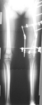 Rosa, Post-op thumbnail of an x-ray, Limb Lengthening, ilizarov hip reconstruction, proximal femoral osteotom, femoral osteotomy, limb realignment