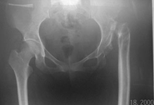 Rosa, Pre-op thumbnail of an x-ray, Limb Lengthening, hip infection, severe limp, completel hip destruction