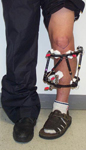 Luis, Post-op thumbnail image, Limb Lengthening, osteotomy proximal tibia, ilizarov taylor spatial frame
