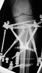Luis, Post-op thumbnail of an x-ray, Limb Lengthening, osteotomy proximal tibia, ilizarov taylor spatial frame