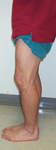 Luis, Pre-op thumbnail Image, Limb Lengthening, fractured tibia, arthritis of the knee, varus, flexion, internal rotation deformity proximal tibia