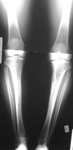 Luis, Pre-op thumbnail of an x-ray, Limb Lengthening, fractured tibia, arthritis of the knee, varus, flexion, internal rotation deformity proximal tibia